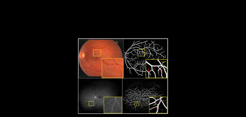 Canfod strwythurau fasgwlaidd o fewn y retina yn awtomataidd.