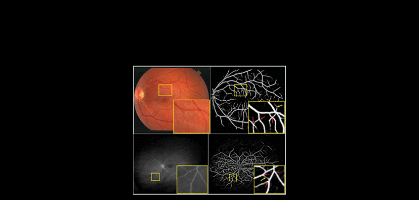 Automated detection of vascular structures within the retina.